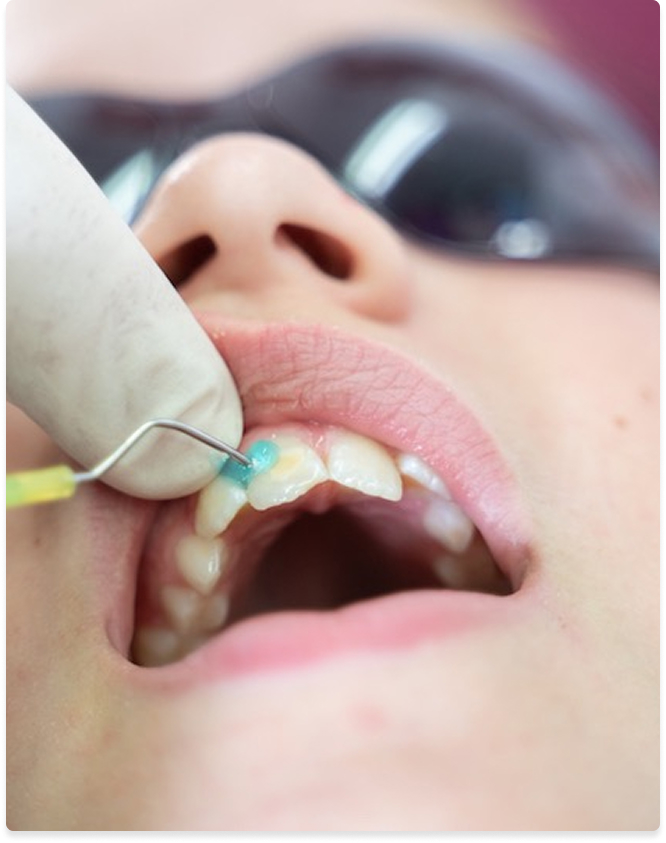 Fluoride treatment at Kennedy Dental Care